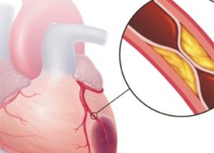 Xơ vữa động mạch: biến chứng sớm nhất của mỡ máu