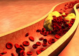 Tìm hiểu về rối loạn lipid máu (rối loạn mỡ máu)