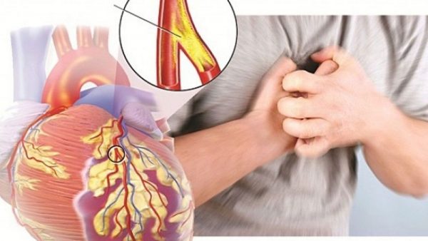 Bệnh xơ vữa động mạch vành: nguyên nhân, triệu chứng và hướng điều trị hiệu  quả – Kyoman