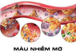 Máu nhiễm mỡ : nguyên nhân, triệu chứng và cách điều trị